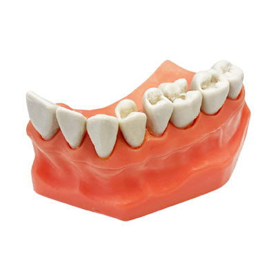 Tipodonto-con-cavidades-adysa.-Deposito-Dental-Dentalmex